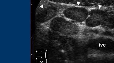 Fig. 5. A 14 year old boy with mesenteric adenitis. Sonogram of the right lower quadrant shows a cluster of enlarged mesenteric lymph nodes (arrowheads). The appendix was normal (not shown) and no other abnormalities were found.
