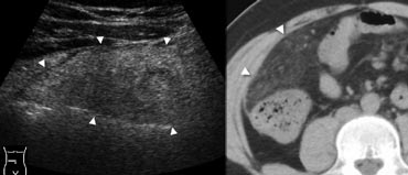 Fig. 8.- 41-year-old man with omental infarction. A, Sonography of the right middle abdomen shows a large area of inflamed intraperitoneal fat (arrowheads). B, Unenhanced CT depicts the lesion as a cake-like area of dense inflamed omental fat (arrowheads), larger than in epiploic appendagitis and lacking a hyperattenuating ring.