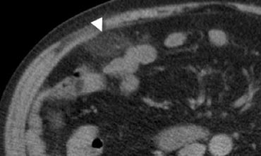 Fig. 9.- 47-year-old woman with acute right lower quadrant pain. Unenhanced CT shows an ovoid inflamed fatty mass (arrowhead) with normal regional bowel loops. The shape and size of the lesion suggests epiploic appendagitis, but the lesion does not contain a hyperattenuating ring. In this case, it is difficult to discriminate between epiploic appendagitis or a small omental infarction.