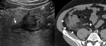 Fig. 10.-  51-year-old man with right-sided colonic diverticulitis. A,  Unenhanced CT shows extensive with fat-standing along the cecal wall (arrowheads), and a normal appendix (arrow). B, Sonography reveals the cause of the inflammation by depicting an inflamed cecal diverticulum (arrow) centred in the hyperechoic fat.