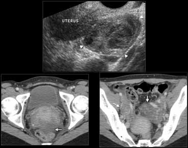 Fig. 12.- 39-year-old woman with pelvic inflammatory disease.A, Endovaginal sonography shows an inhomogeneously enlarged right ovary (arrowheads).B and C, Contrast-enhanced CT shows enlargement of the ovaries (B, arrows) with ill-defined contours of the ovaries and uterus, and some free pelvic fluid (C, arrow).