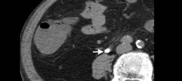 Fig. 13.  77-year-old man with a right ureteral stone.Unenhanced CT shows an obstructing calcification (arrow) within the distal ureteral lumen.
