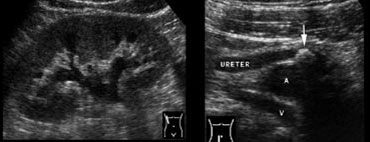 Fig. 14.  40-year-old woman with a ureteral stone.A and B, Sonography shows right-sided hydronephrosis (A), and an obstructing calculus (B, arrow) in the distal ureter at the level of the iliac vessels.
