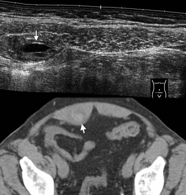 Fig. 15.- 68-year-old woman with a rectus sheath hematoma.A, Sonography depicts a small painfull lesion (arrow) within the sheath of the rectus abdominis muscle in the right lower quadrant. The lesion contains a fluid-fluid level.B, Unenhanced CT depicts the lesion as a partly hyperdense mass (arrow) within the rectus sheath.