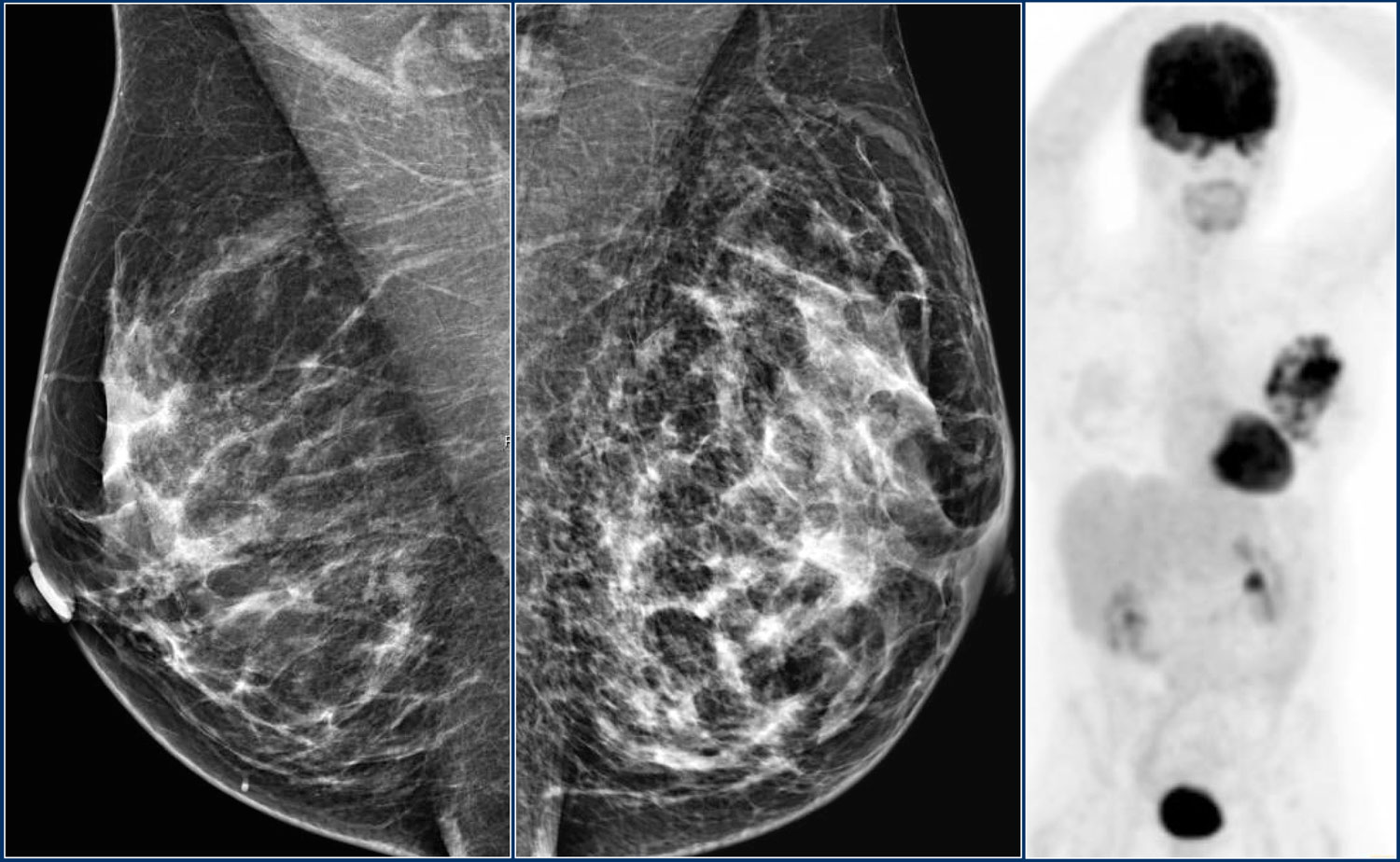 Фиброзная мастопатия на маммографии