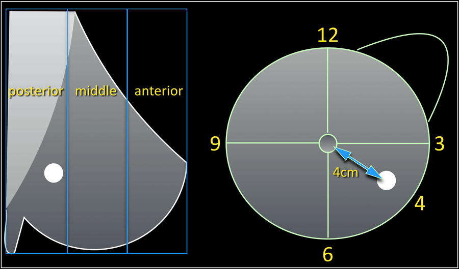 A mass is seen in the outer lower quadrant of the left breast at 4 o' clock in the posterior portion of the breast at 4cm distance from the nipple.
