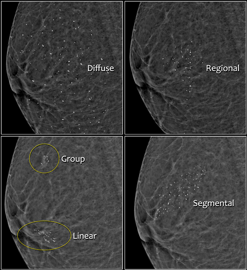breast calcification clusters