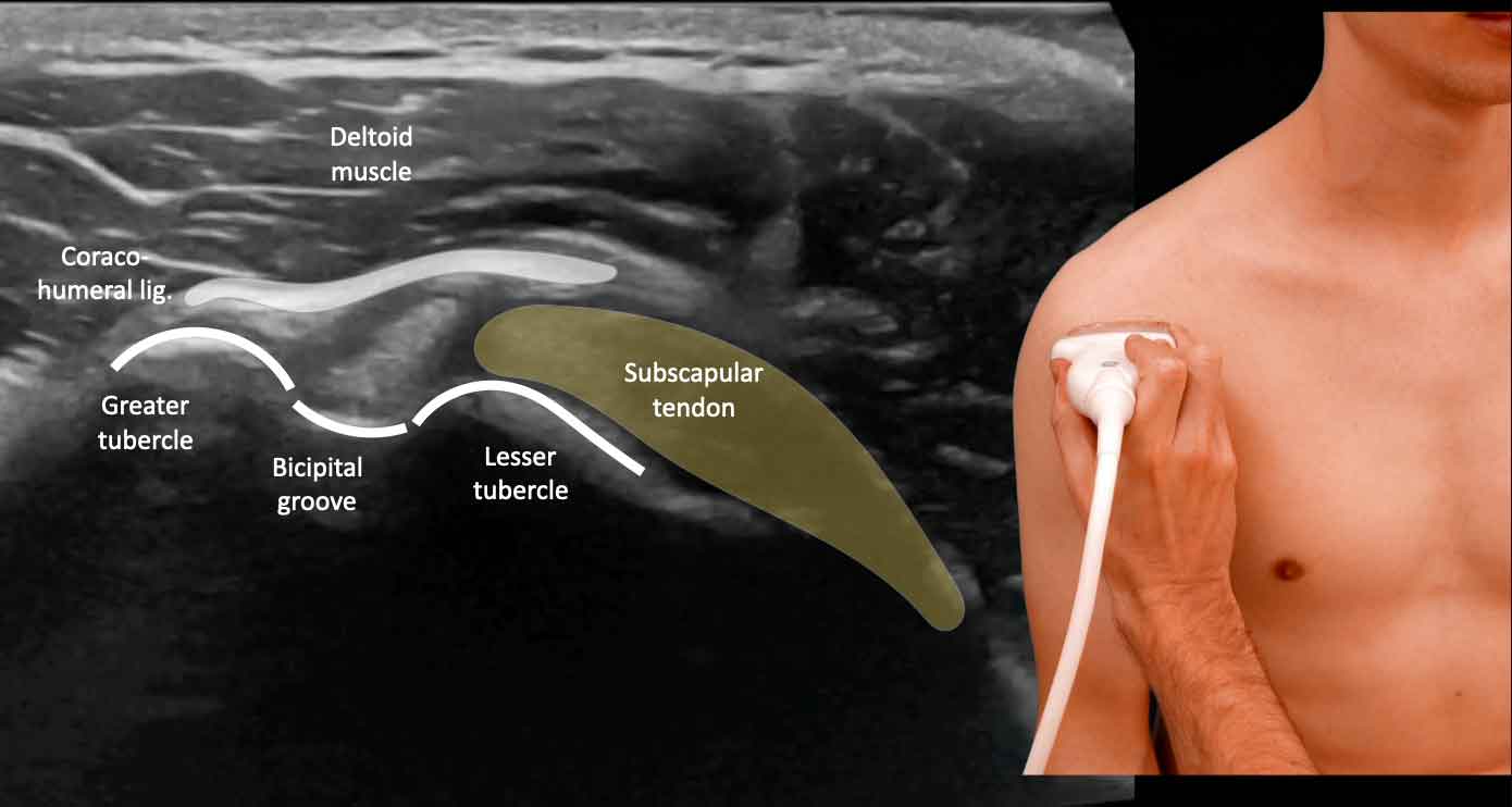 Anterior Shoulder Anatomy Ultrasound