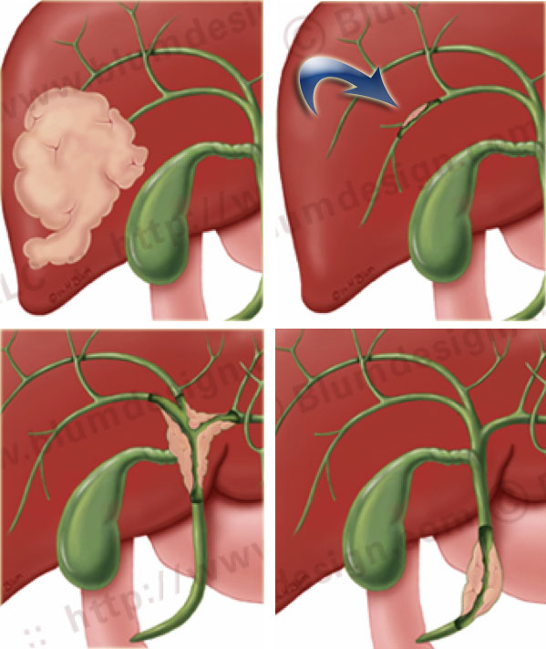 Typical locations of cholangiocarcinoma.
