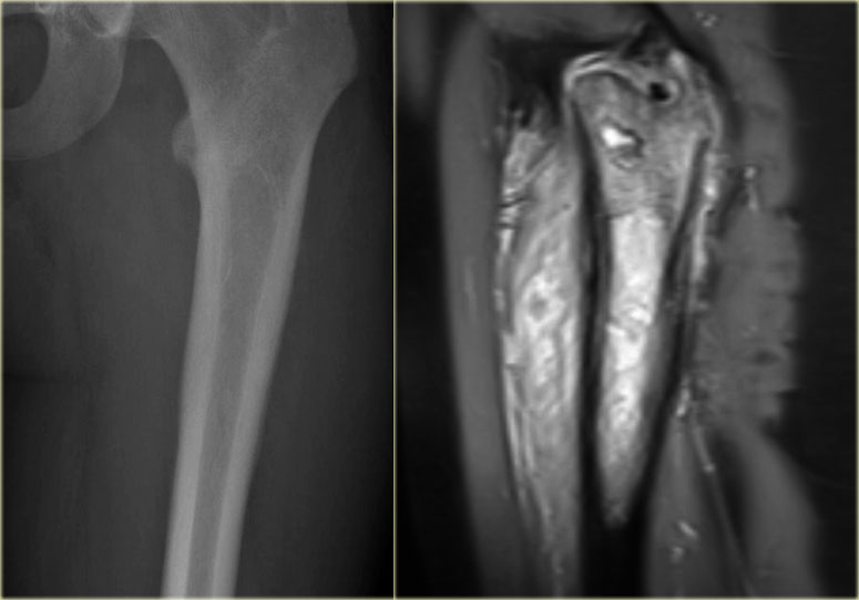 Ewing's sarcoma with permeative growth and normal X-ray.
