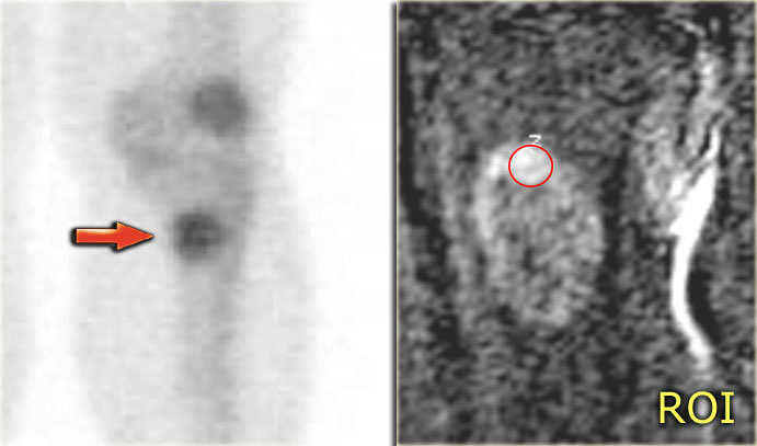 Low grade chondrosarcoma: Bone scintigraphy (left) and fast dynamic contrast enhanced MR (right)