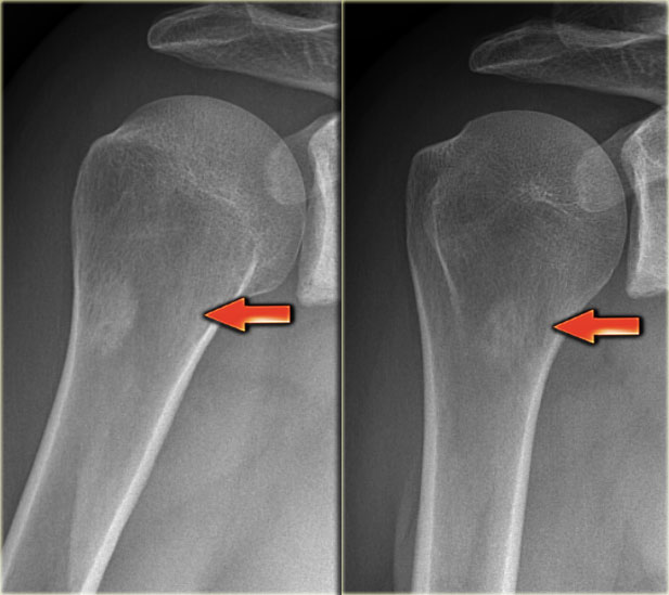 The Radiology Assistant : Bone tumor H-O