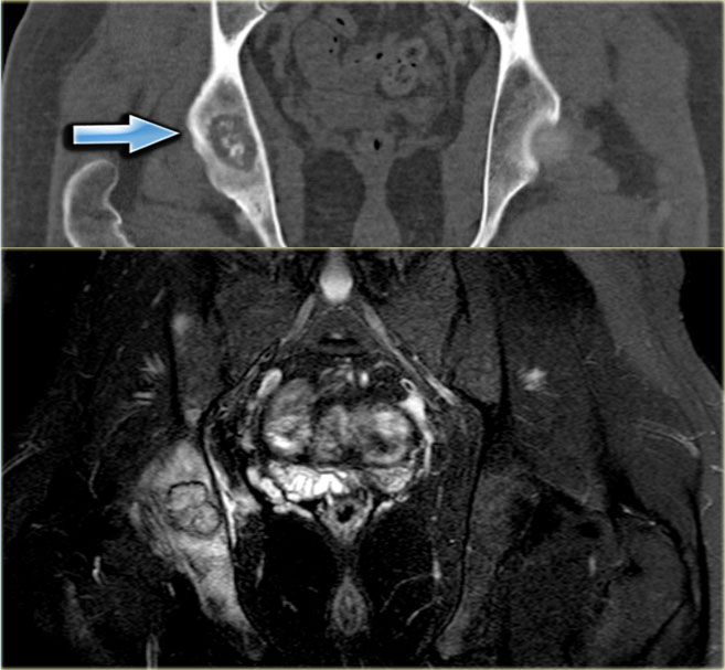 Osteoblastom Radiologie