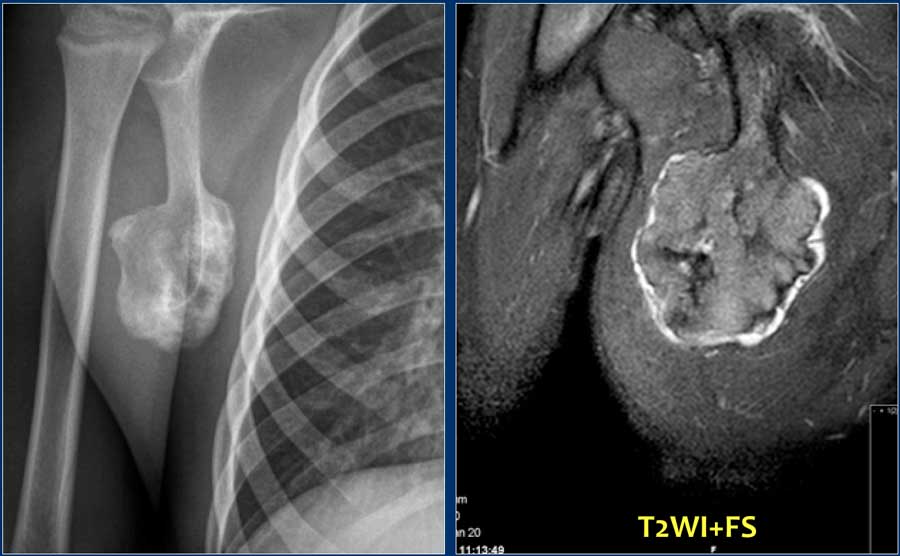 The Radiology Assistant : Bone tumor H-O