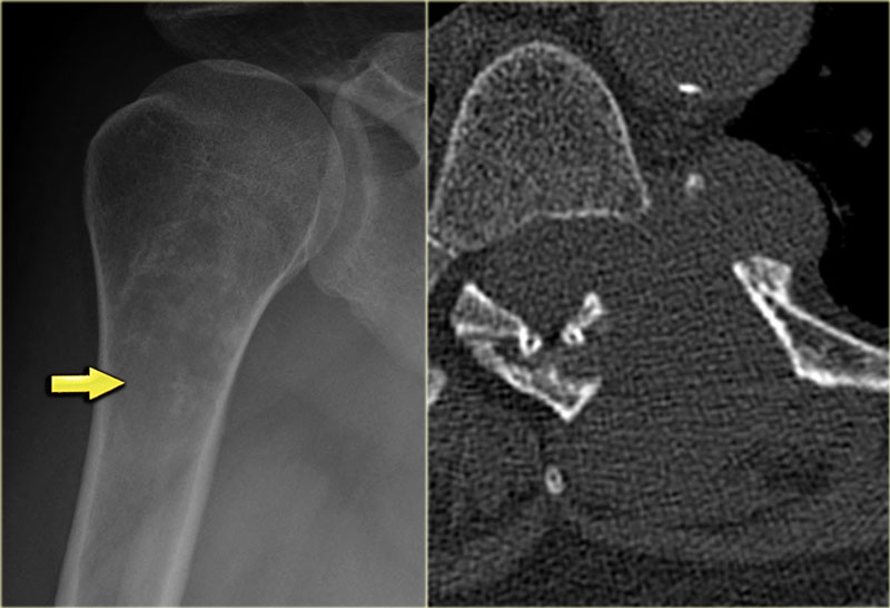 The Radiology Assistant Osteolytic Ill Defined Bone Tumors