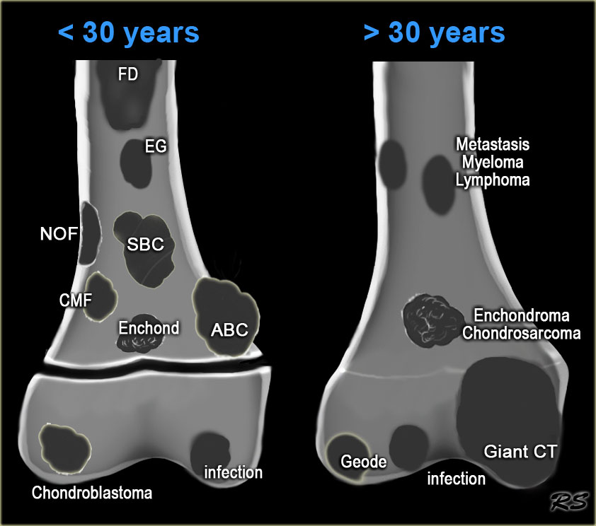 Benign cancer of bone. Oxiuros incubacion, Benign cancer of bone