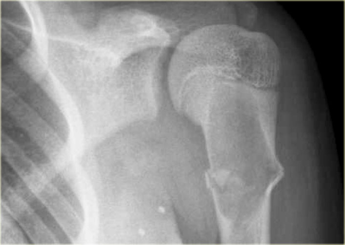 SBC: well-defined osteolytic lesion without expansion of the proximal meta-diaphysis of the humerus with pathologic fracture