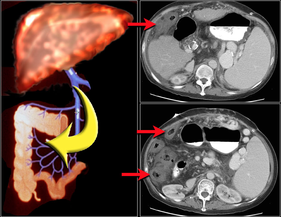 The Radiology Assistant : CT-pattern of Bowel wall thickening