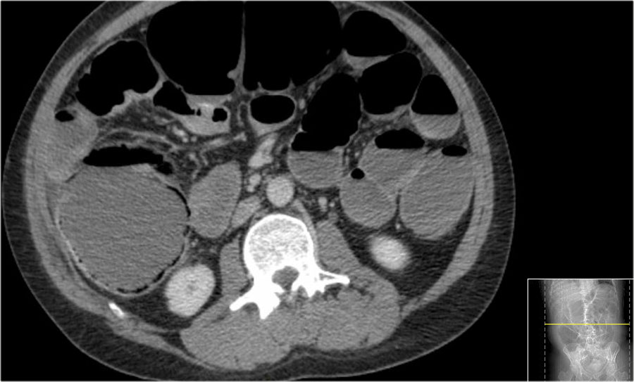 The Radiology Assistant Bowel wall thickening CTpattern