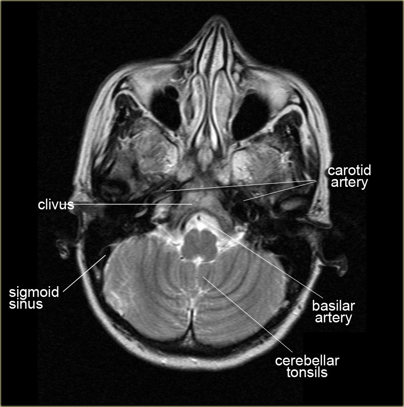 Mri anatomy brain The Radiology