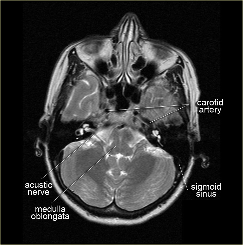 The Radiology Assistant : Brain Anatomy