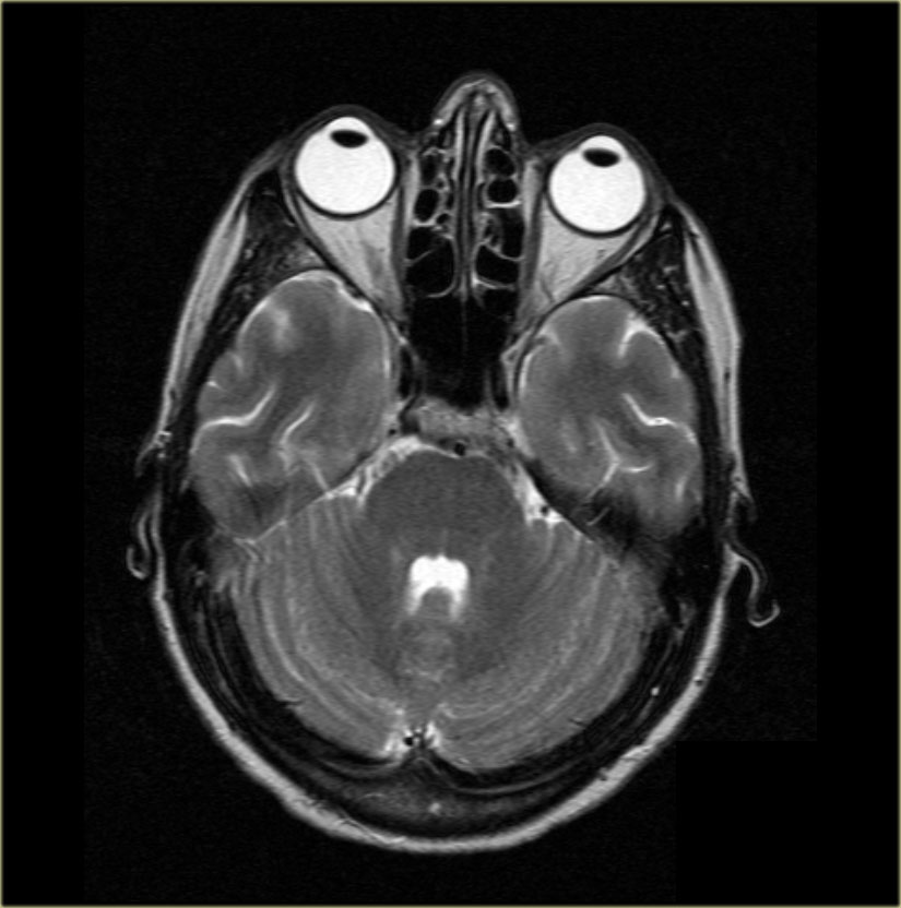 The Radiology Assistant : Brain Anatomy