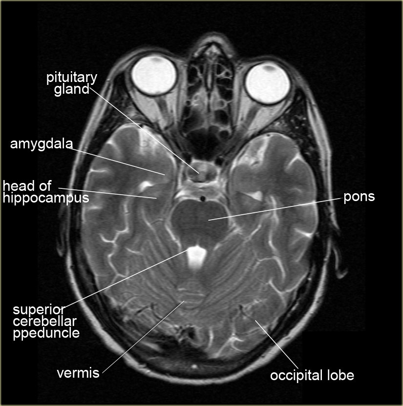 Ct Brain Cross Sectional Anatomy