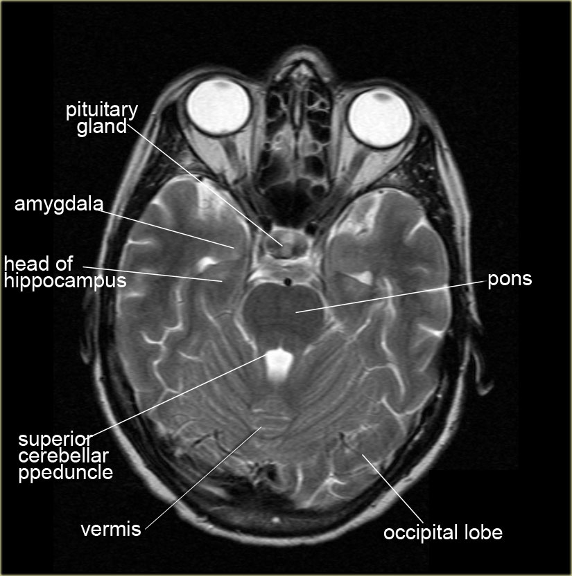 Ct Scan Anatomy Of Brain - Anatomy Drawing Diagram