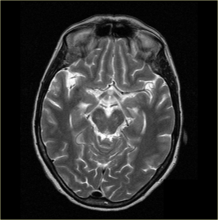 Brain Anatomy Radiopaedia