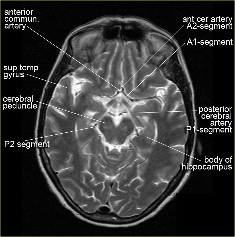 The Radiology Assistant : Brain Anatomy