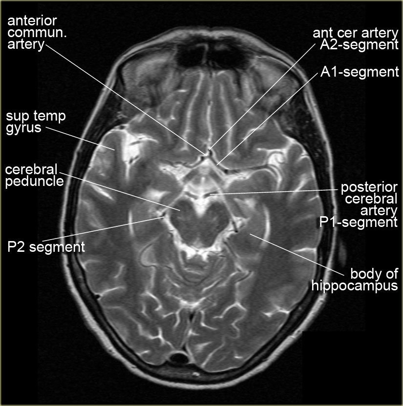 Brain Anatomy On Mri Anatomical Charts And Posters 9661