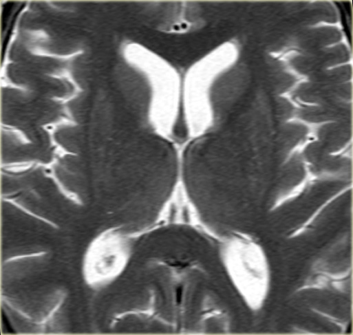 The Radiology Assistant : Brain Anatomy