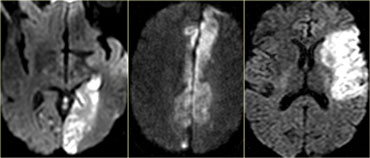 DWI in posterior, anterior and middle cerebral infarction