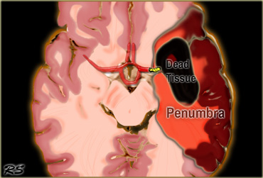 Penumbra: Occlusion of the MCA with irreversibly affected or dead tissue in black and  tissue at risk or penumbra in red.