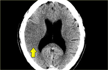MCA infarction: on CT an area of hypoattenuation appearing within six hours is highly specific for irreversible ischemic brain damage.