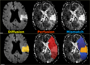 Diffusion in yellow. Perfusion in red. Mismatch in blue is penumbra.