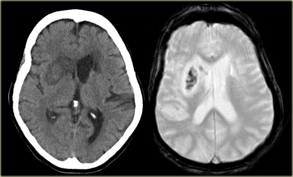 CT and T2W-gradient echo image of a hemorrhagic infarction limited to the territory of the lateral lenticulo-striate arteries