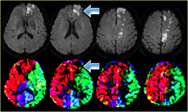 Cortical infarction in the left frontal lobe which is supplied by the right ICA Images courtesy Jeroen Hendrikse (9)