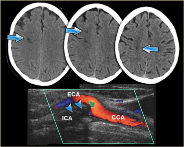 Deep watershed infarction in a patient with an occlusion of the right internal carotid artery