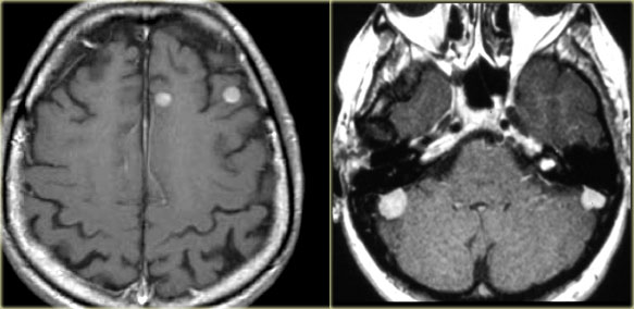 LEFT: Metastases. RIGHT: Multiple meningiomas and a schwannoma in a patient with Neurofibromatosis II