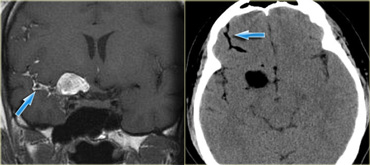 Ruptured dermoid cyst. Coronal T1WI (left) and NECT (right).