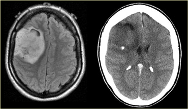 Oligodendroglioma with calcification (PDWI and CT)