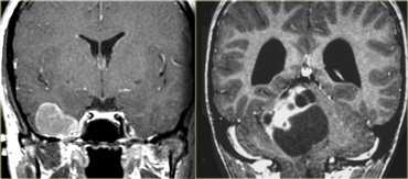 Low grade tumors with enhancement: ganglioglioma (left) and a pilocytic astrocytoma (right)