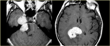LEFT: Schwannoma extending into the middle cranial fossa with homogeneous enhancement RIGHT: Primary Lymphoma known for its vivid enhancement