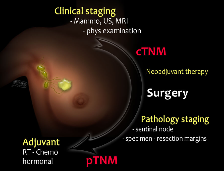 Breast Cancer Tumor Staging Chart