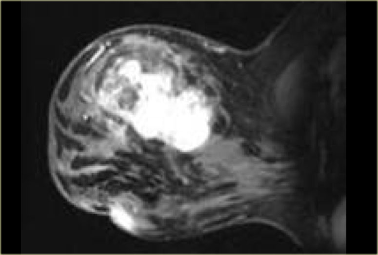 Enhancing mass with an irregular shape, which proved to be an angiosarcoma