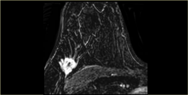 Invasive lobular carcinoma with heterogenous enhancement