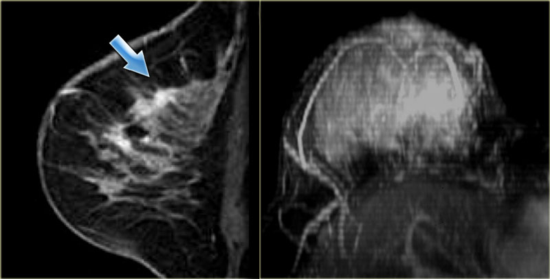 Imaging in Breast Cancer