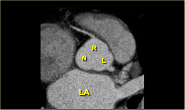 Axial reconstruction depicting the tricuspid aortic valve with its right and left coronary (R and L respectively) and non-coronary cusp (N) 
