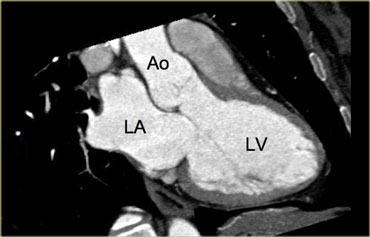 3-chamber view. LA=left atrium, Ao=aorta, LV=left ventricle